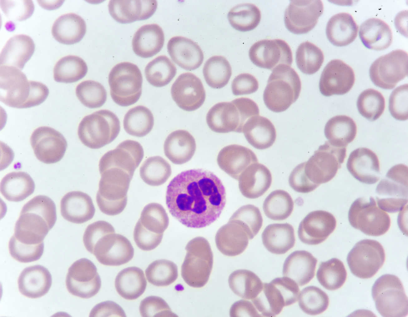 Neutrophil cell (white blood cell) in blood smear