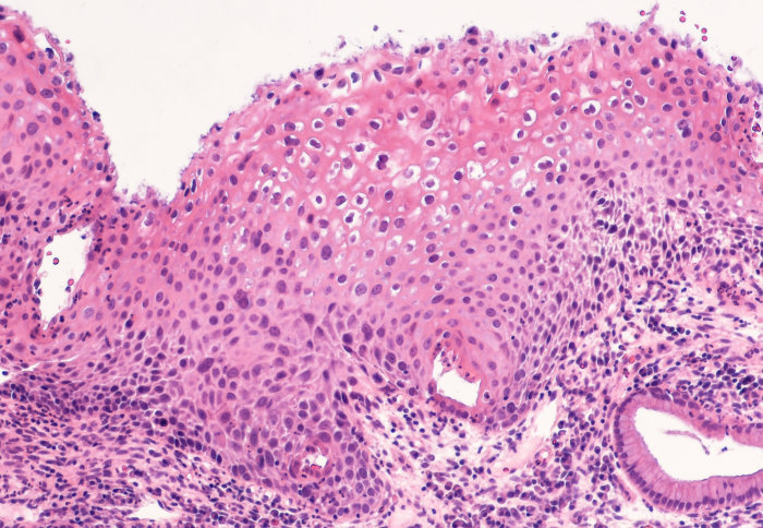 Cervical biopsy showing a low grade lesion