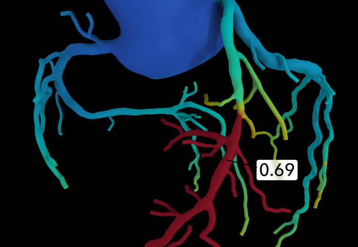 Network of arteries with colours ranging from blue to red, indicating blood flow