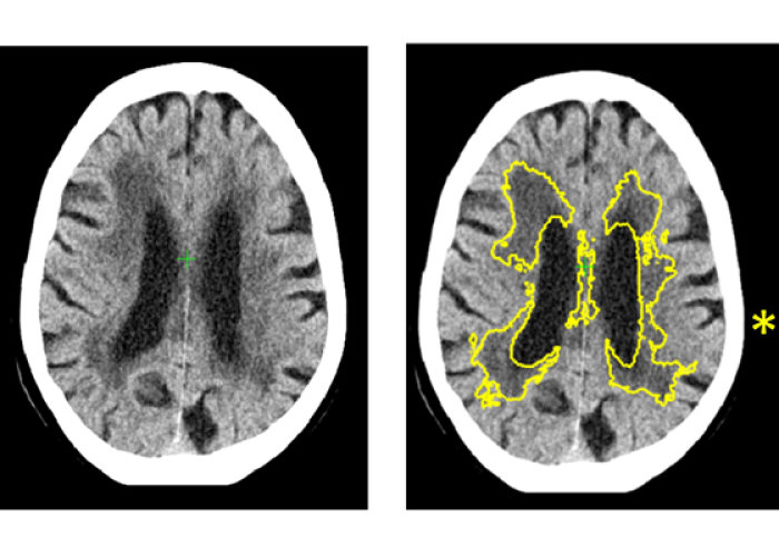 CT of small vessel disease in the brain