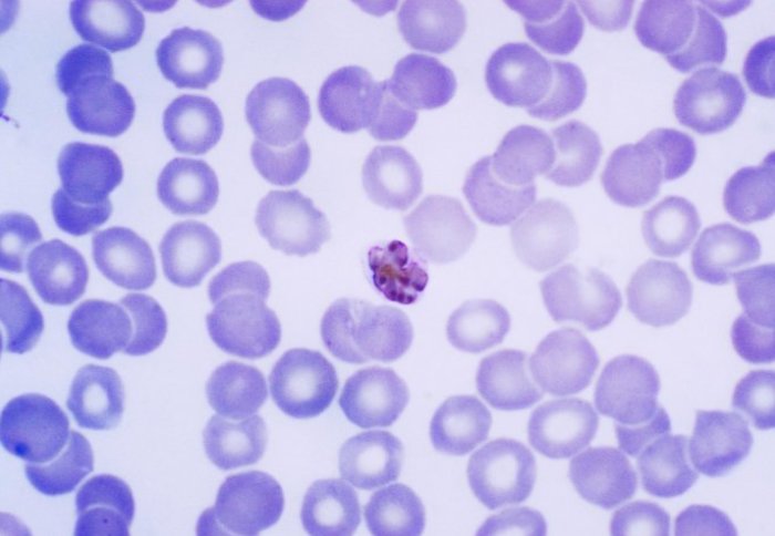 A red blood cell infected with the malaria parasite.