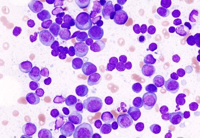 A blood sample with white blood cells stained purple with dye