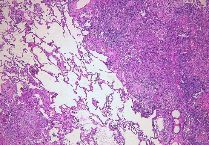 Pulmonary tuberculosis