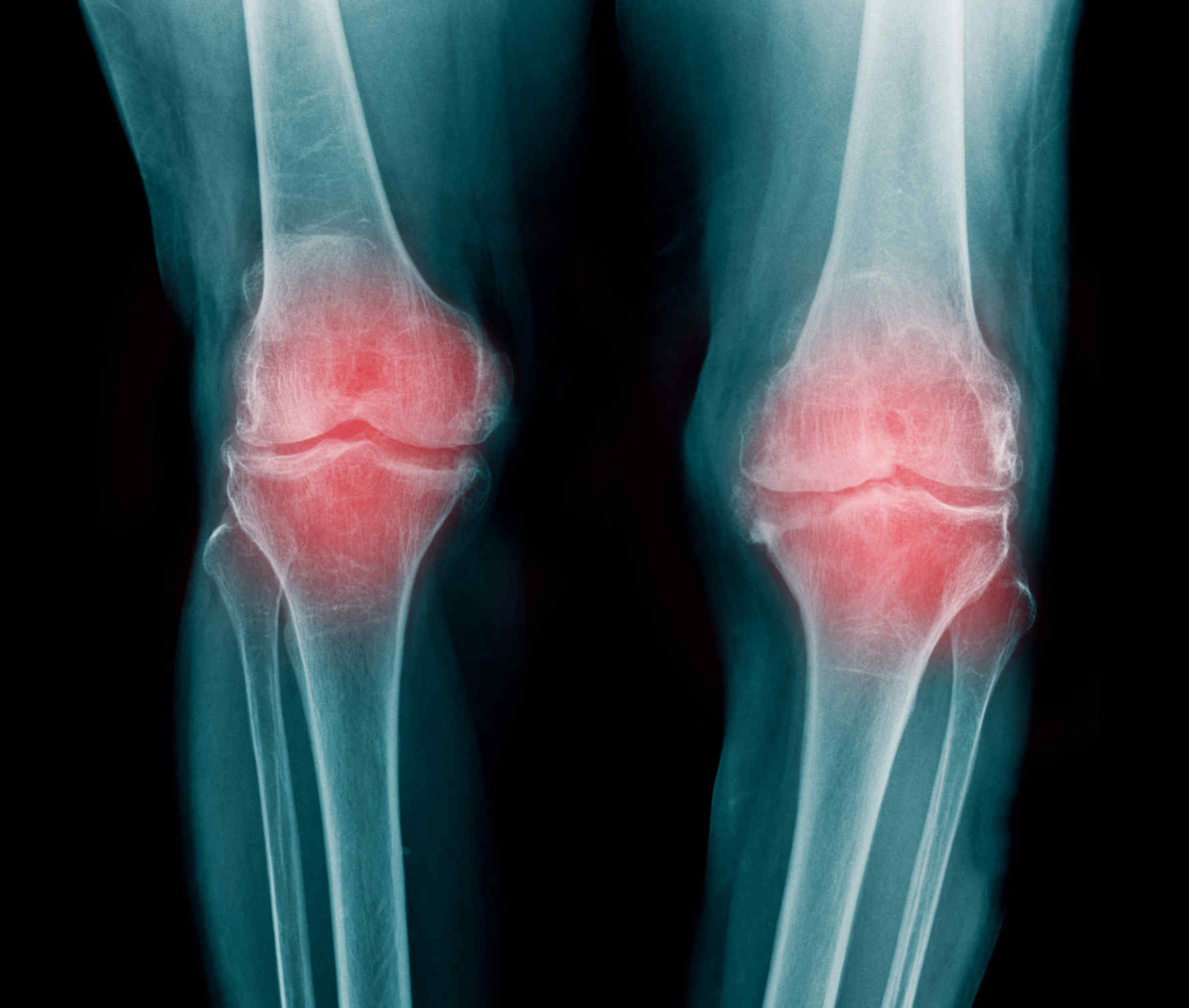 Болезнь суставов артрита. Узуры ревматоидного артрита. Ревматоидный артрит суставы. Ревматоидный артрит коленного сустава. Ревматоидный артрит и остеоартрит.
