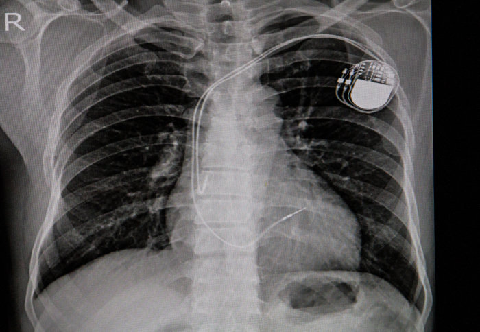 X-ray of pacemaker