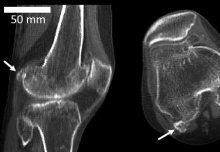 Region, age, and sex decide who gets arthritis-linked ‘fabella’ knee bone