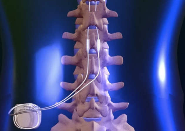 Illustration of a surgical implant attached to the spine