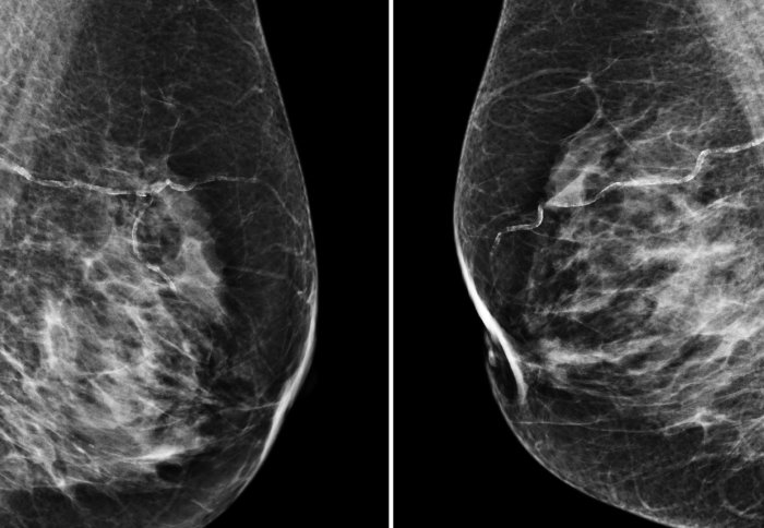 Mammogram images
