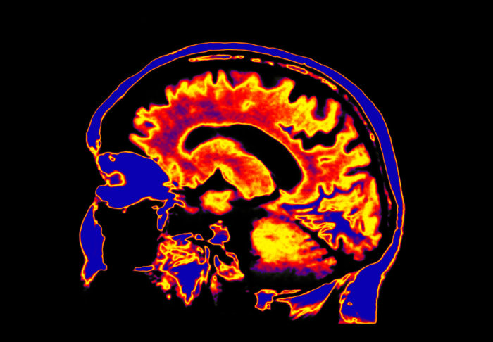 An MRI scan of the human brain