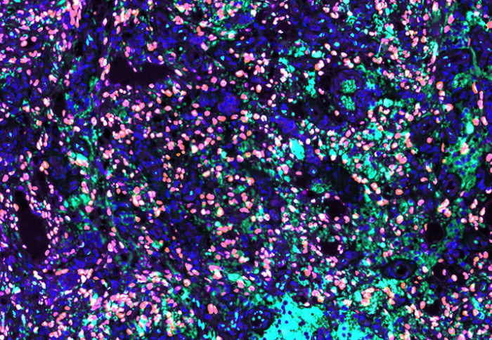 Multiplex immunohistochemistry of an AIDS-associated Kaposi sarcoma skin tumor. LANA is shown in purple, K8.1 in green, PROX1 in orange and SOX18 in turquoise