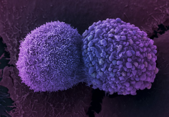 False colour scanning electron micrograph showing two lung cancer cells. These cells were grown using cell culture techniques.