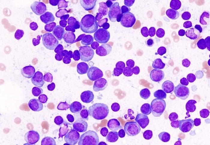 Histopathological image of multiple myeloma