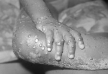 "Monkeypox cases not a threat but a reminder of our vulnerability to viruses"