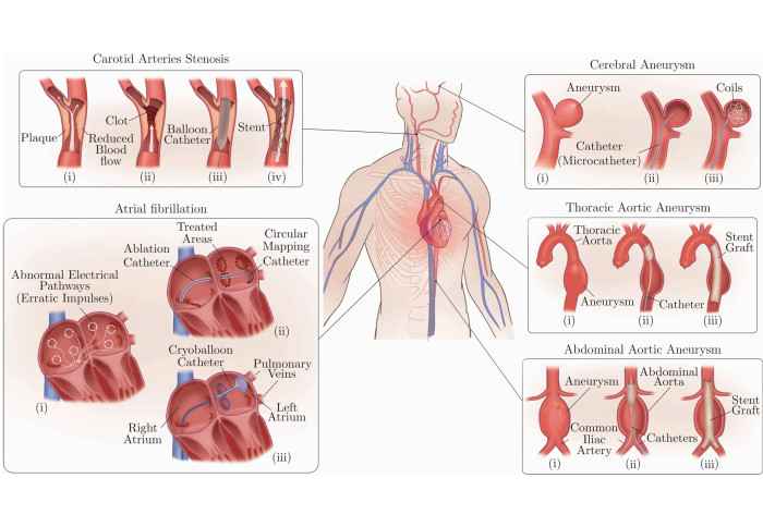 X-Ray to MR: the progress of flexible instruments for endovascular navigation