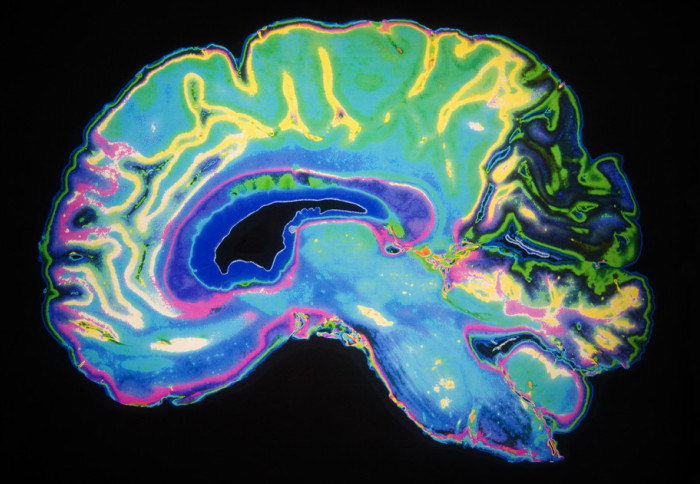 Coloured MRI Brain Scan