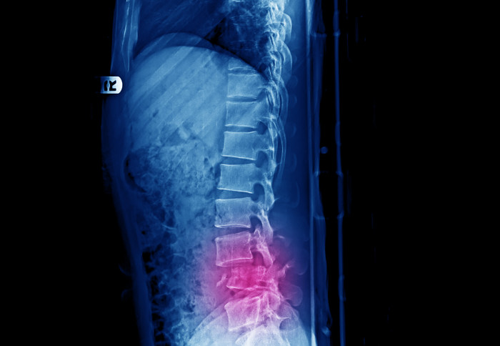X-ray image of a spine fracture