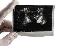 Ultrasound scan can diagnose prostate cancer