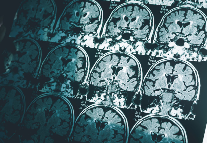 A single MRI scan of the brain could be enough to diagnose Alzheimer’s disease, according to new research by Imperial College London. The research u