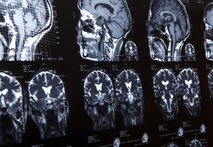 MRI brain scans