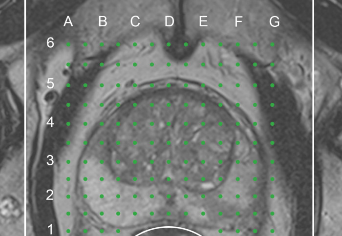 biopsy-grid-cropped