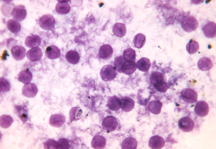 Photomicrograph of a lung tissue impression smear, revealing the presence of numerous, Pneumocystis jirovecii.