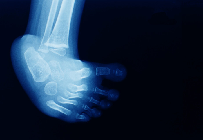 X-ray image of a healthy baby foot
