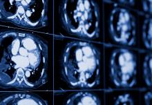 ‘Virtual biopsy’ uses AI to help doctors assess lung cancer 