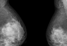 Scientists investigate a new therapy for breast cancer that spreads to the brain