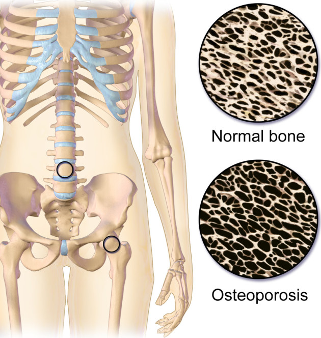 Osteoporosis