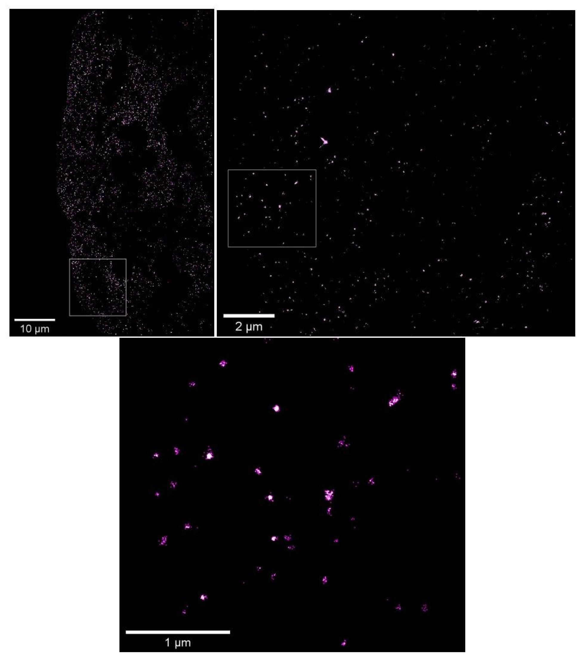 SARS-CoV-2 virus infects human liver organoids, shown in purple