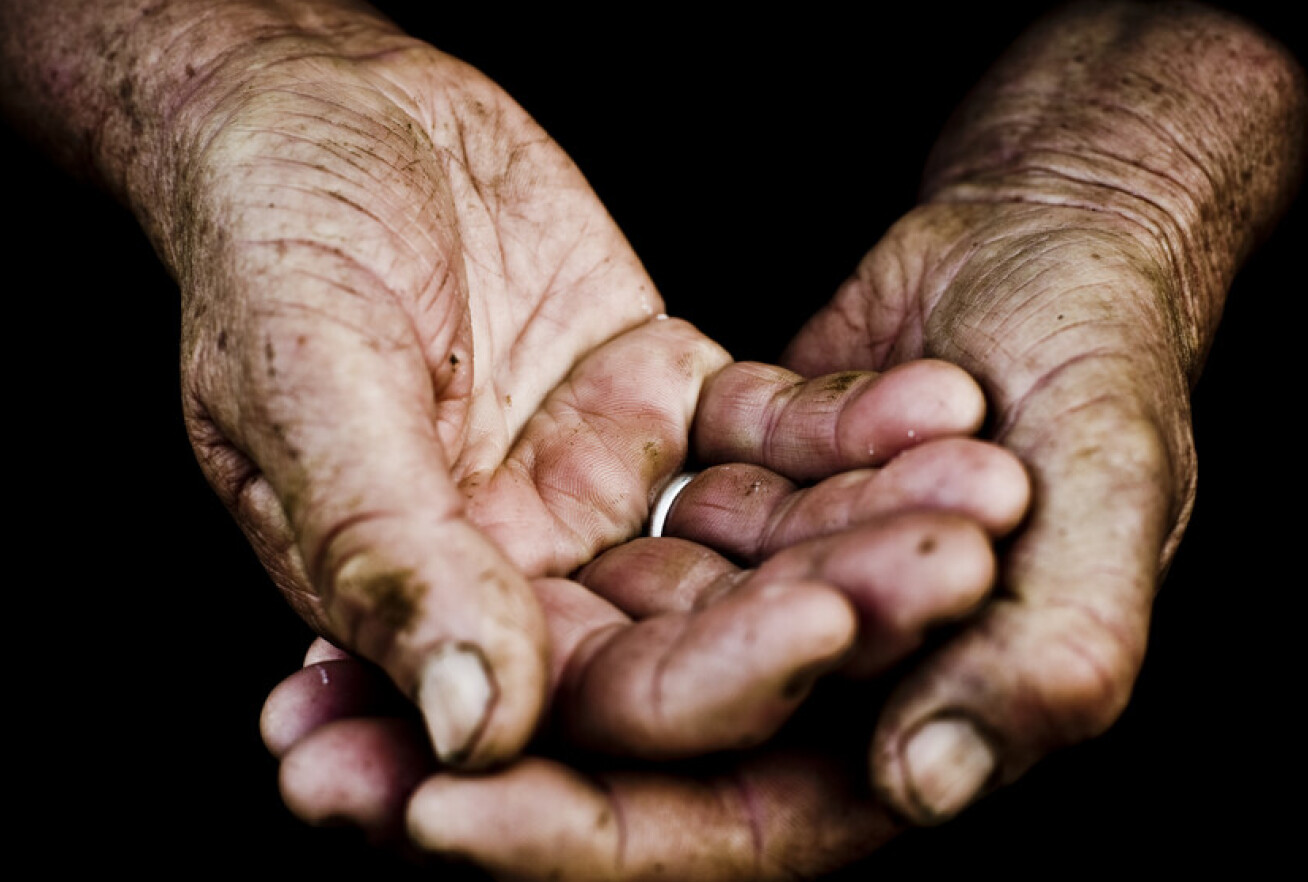 Photo shows hands swollen with arthritis 