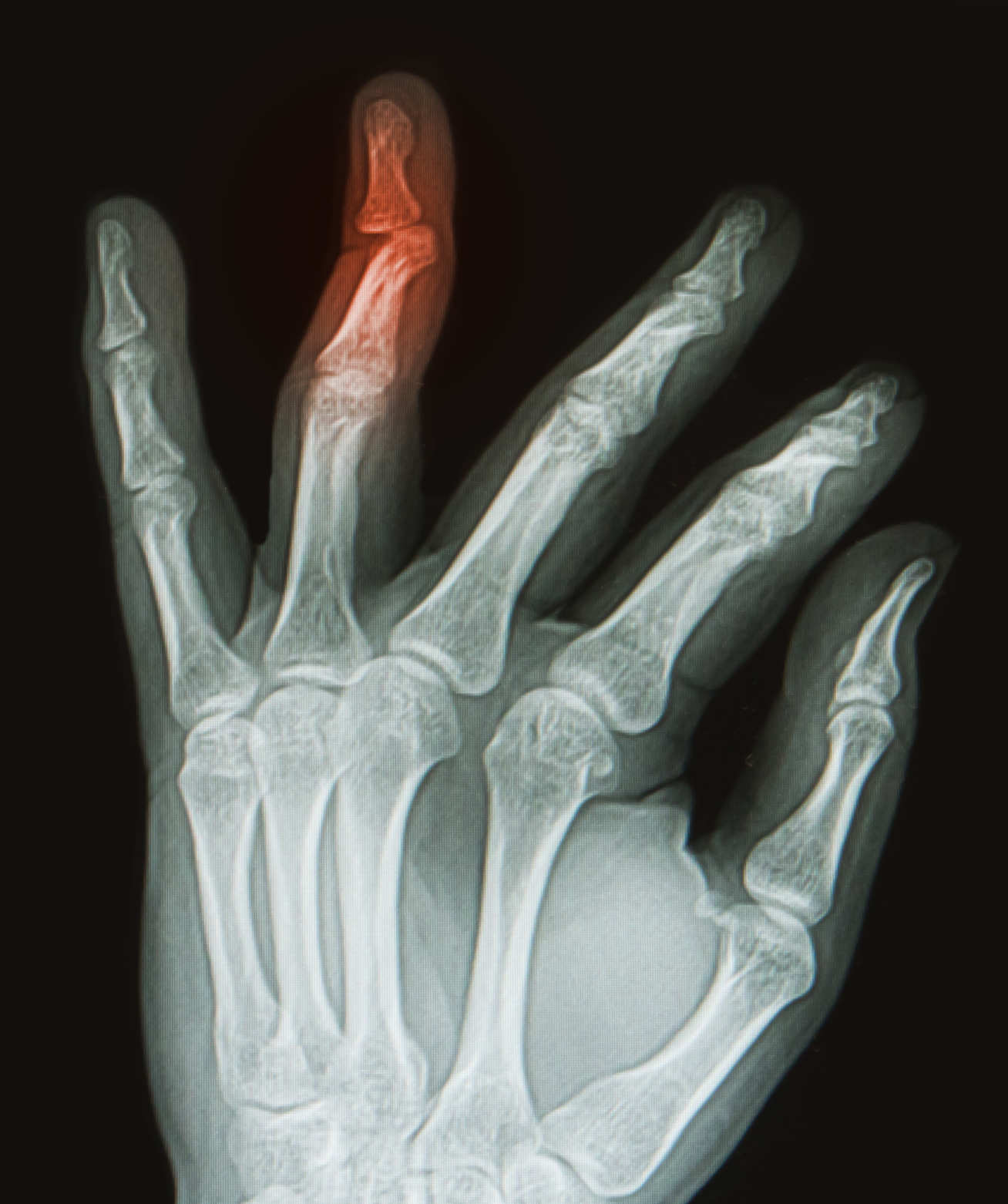 X-ray of hand with broken ring finger