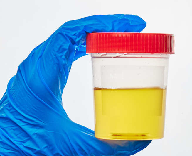 Photo of person with gloves on holding a pot of urine