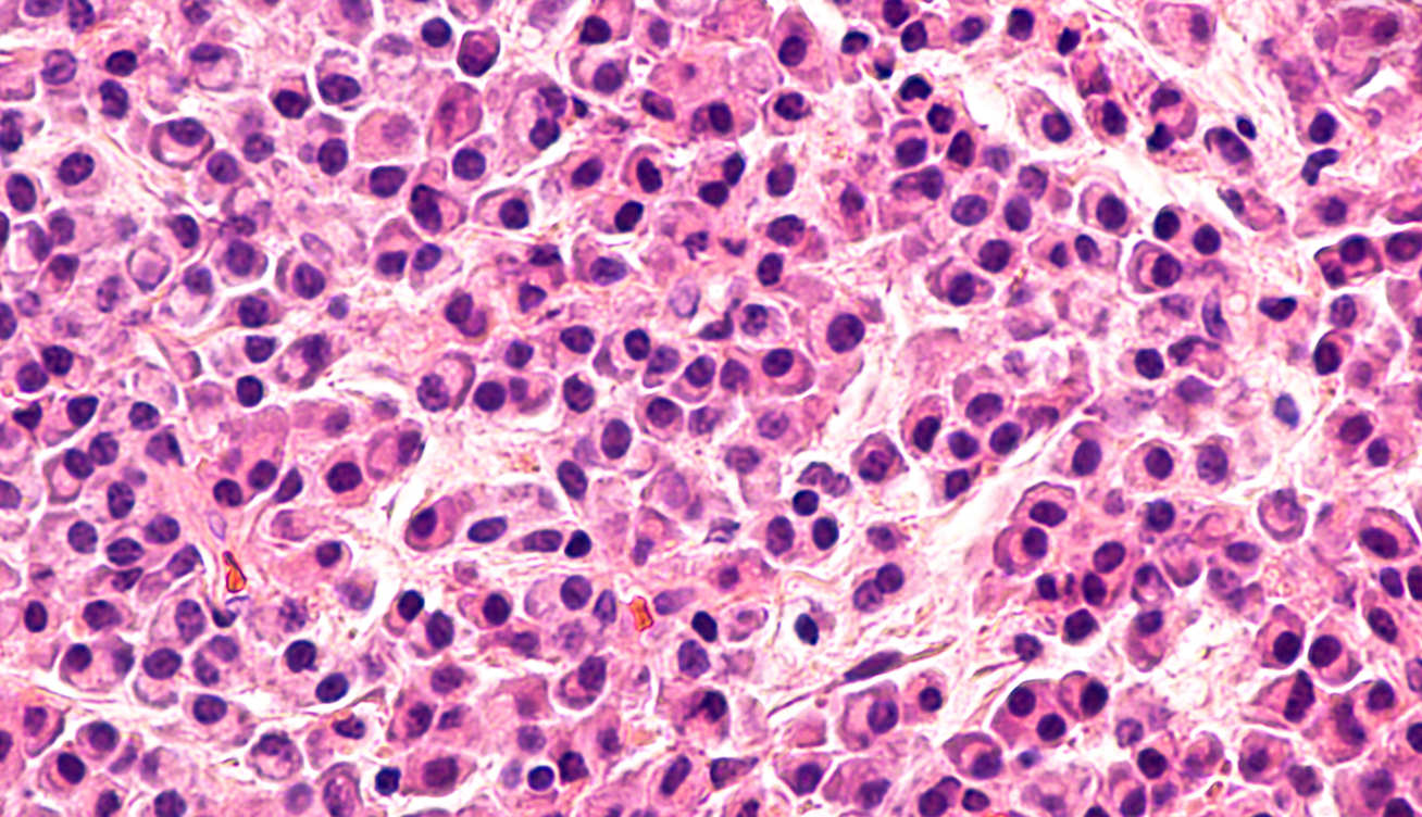  Pathology microscopic of bone biopsy of multiple myeloma