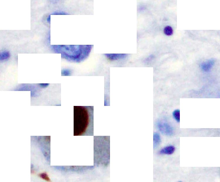 A brown stain indicating the presence of alpha-synuclein in a Lewy body, obscured by white blocks to represent missing information about the protein