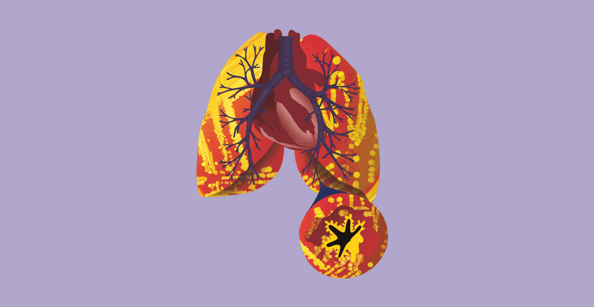 Illustration of Gram stain of healthy human broncho-alveolar lavage fluid,