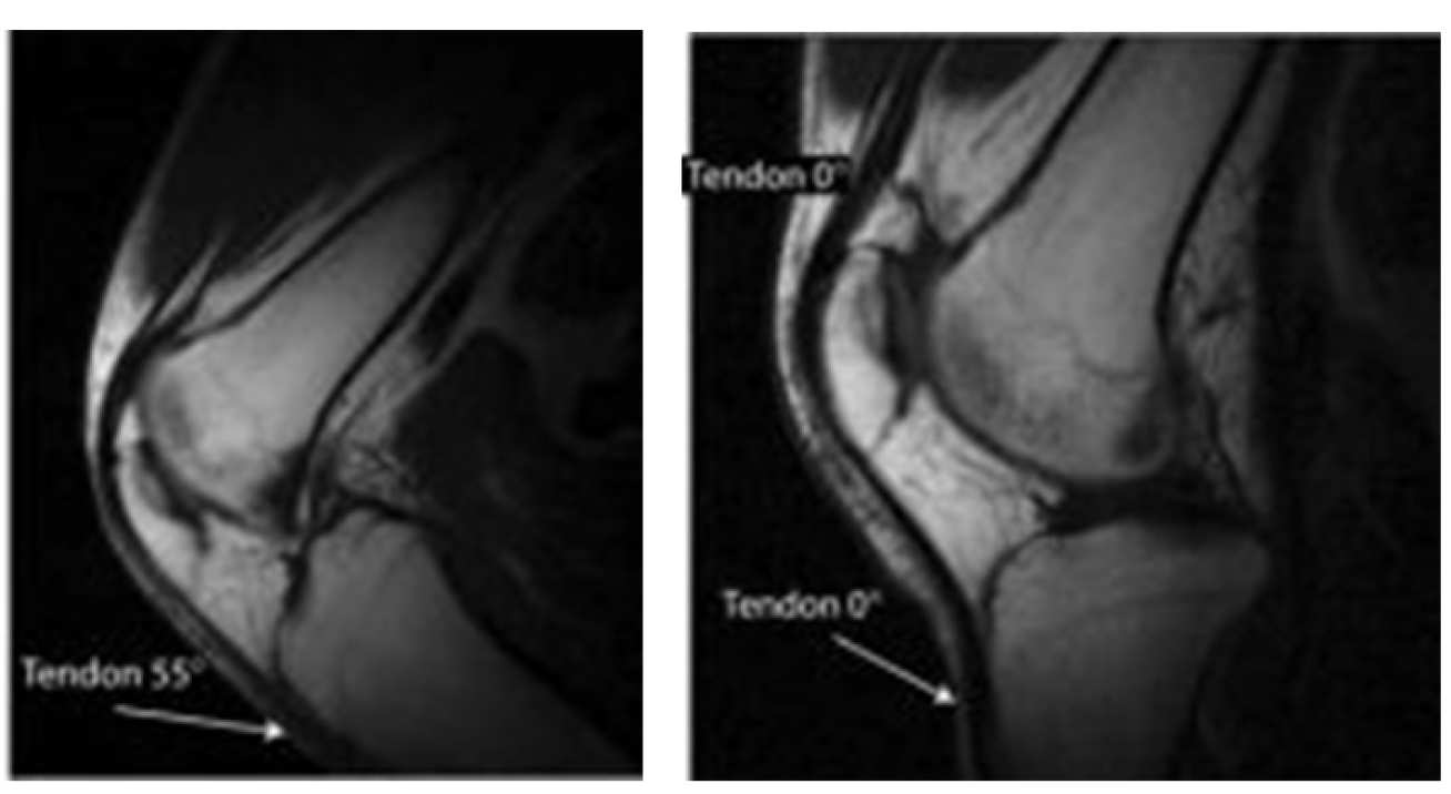 Patella tendon in the knee