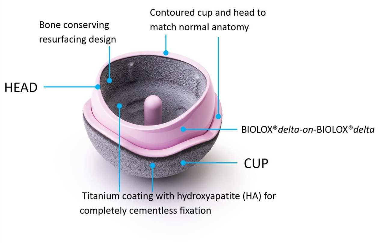 H1 Implant.Bone conserving resurfacing design,  Contoured cup and head to Match normal anatomy, BIOLOX® delta-on-BIOLOX ® delta,  CUP, Titanium coating with hydroxyapatite (HA) for completely cementless fixation, HEAD.