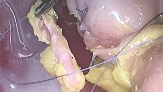 lap appendicectomy