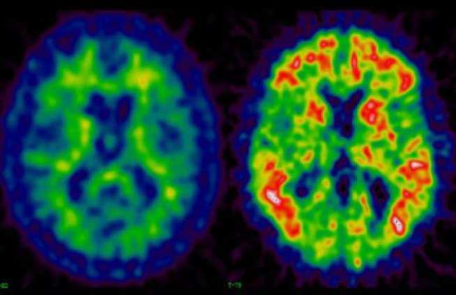 Amyloid imaging in a healthy (L) and control (R)