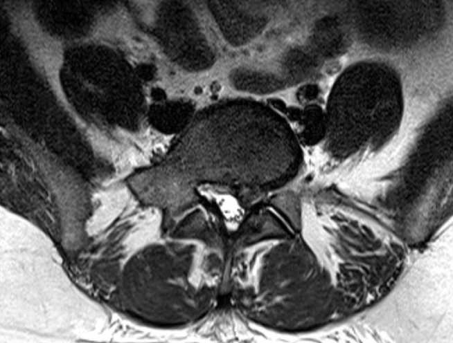T2-weighted MRI axial view of the L5/S1 disc in a patient with a unilateral disc bulge