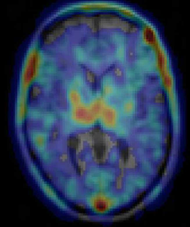 Chronic inflammation measured using positron emission tomography following traumatic brain injury (months since injury below individual patients imaging).