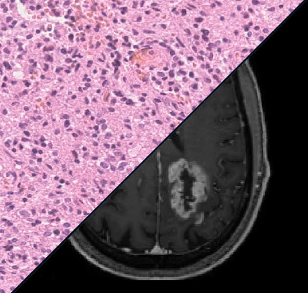 Brain tumour classification