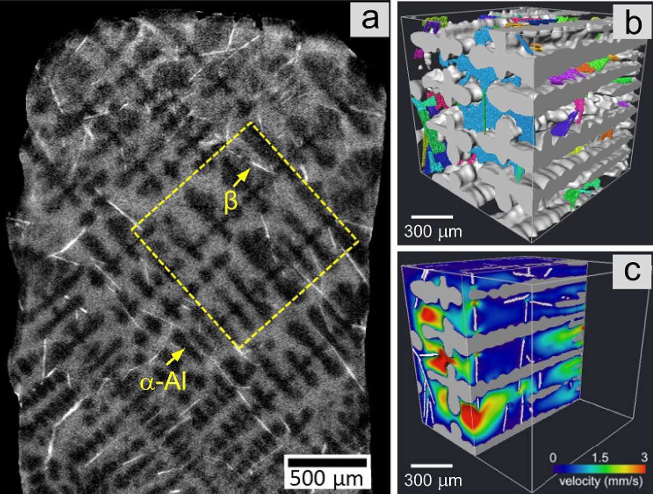 (a) Al-Si-Cu-Fe solidifying microstructure; (b) intermetallics (coloured) and dendrites (light grey) rendered in 3D from an ROI [yellow square in (a)]; (c) CFD simulated velocity field showing how intermetallics block liquid flow.