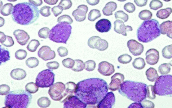 Normal cells flowing in the body and blood cells (blasts) from a patient with acute lymphoma
