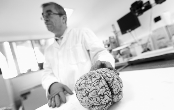 Professor Reynolds with a human brain donated by a patient with MS.