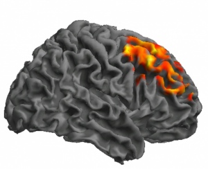 Areas of abnormal brain activity in NFL alumni