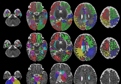 Columns of images show brain scans of newborn babies