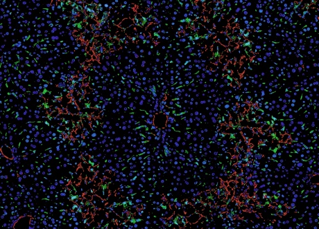 Fibrosis in the liver