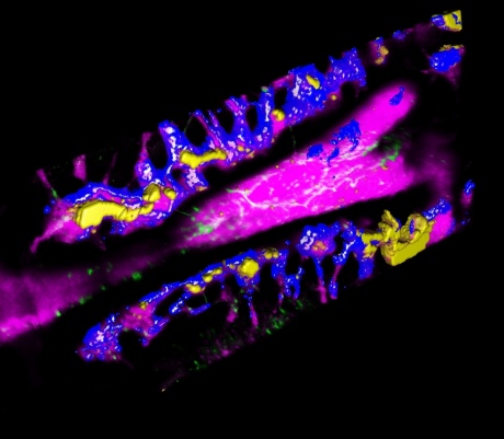 Environments in bone marrow as they are invaded by leukaemia cells